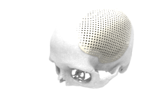 LaserImplant Cranial plate